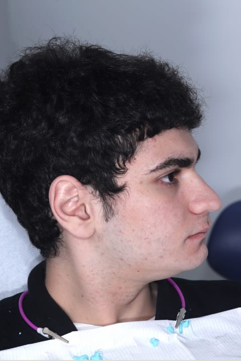 Case 01, Young male patient side profile before FACE Dentistry treatment showing retruded jaw position