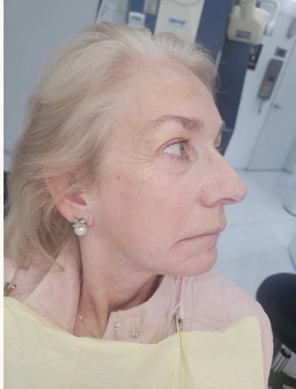 Case 02, Female patient facial profile before overjet correction