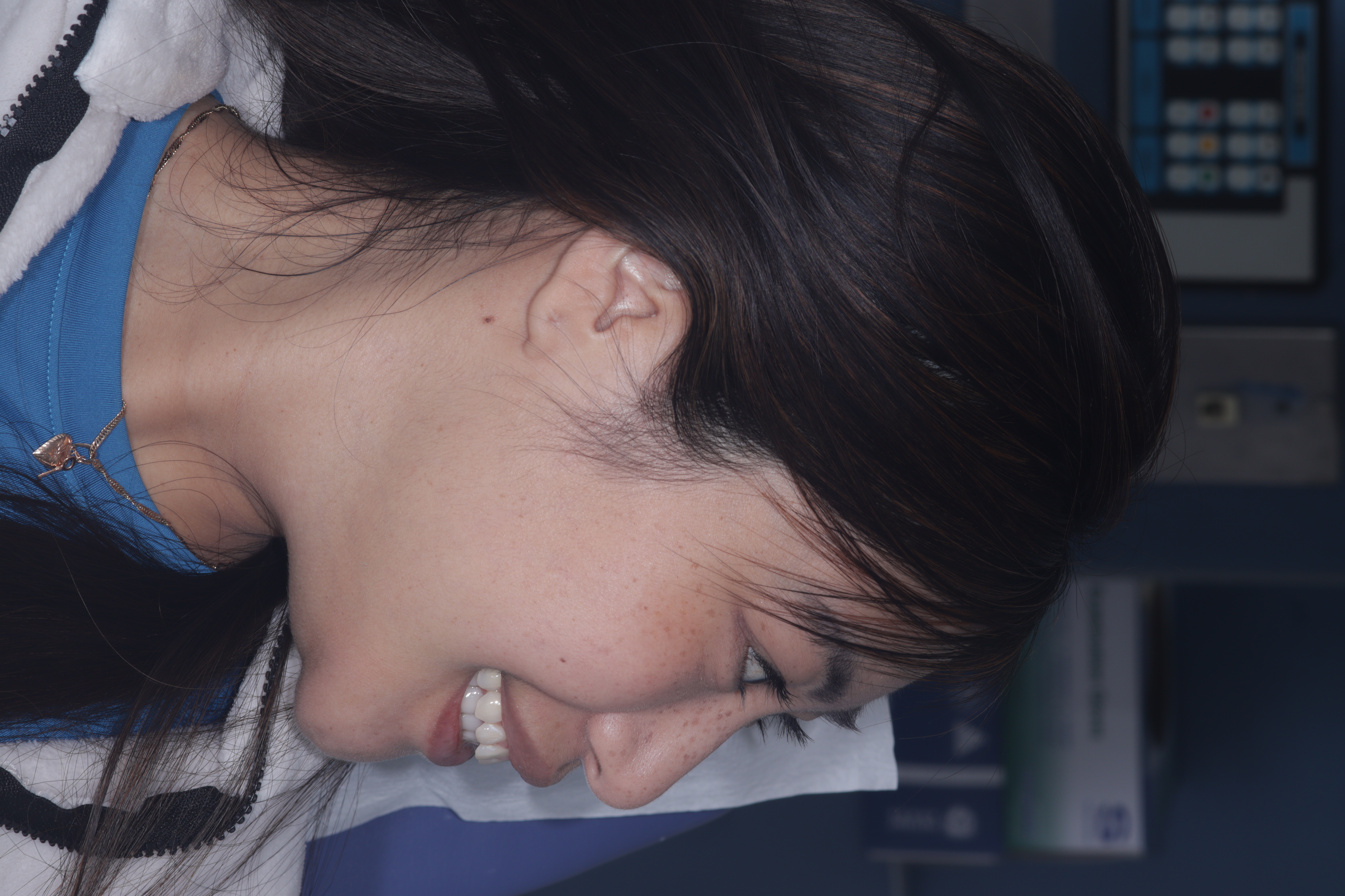 Case 05, Female patient facial profile restored through non-surgical bite dimension correction