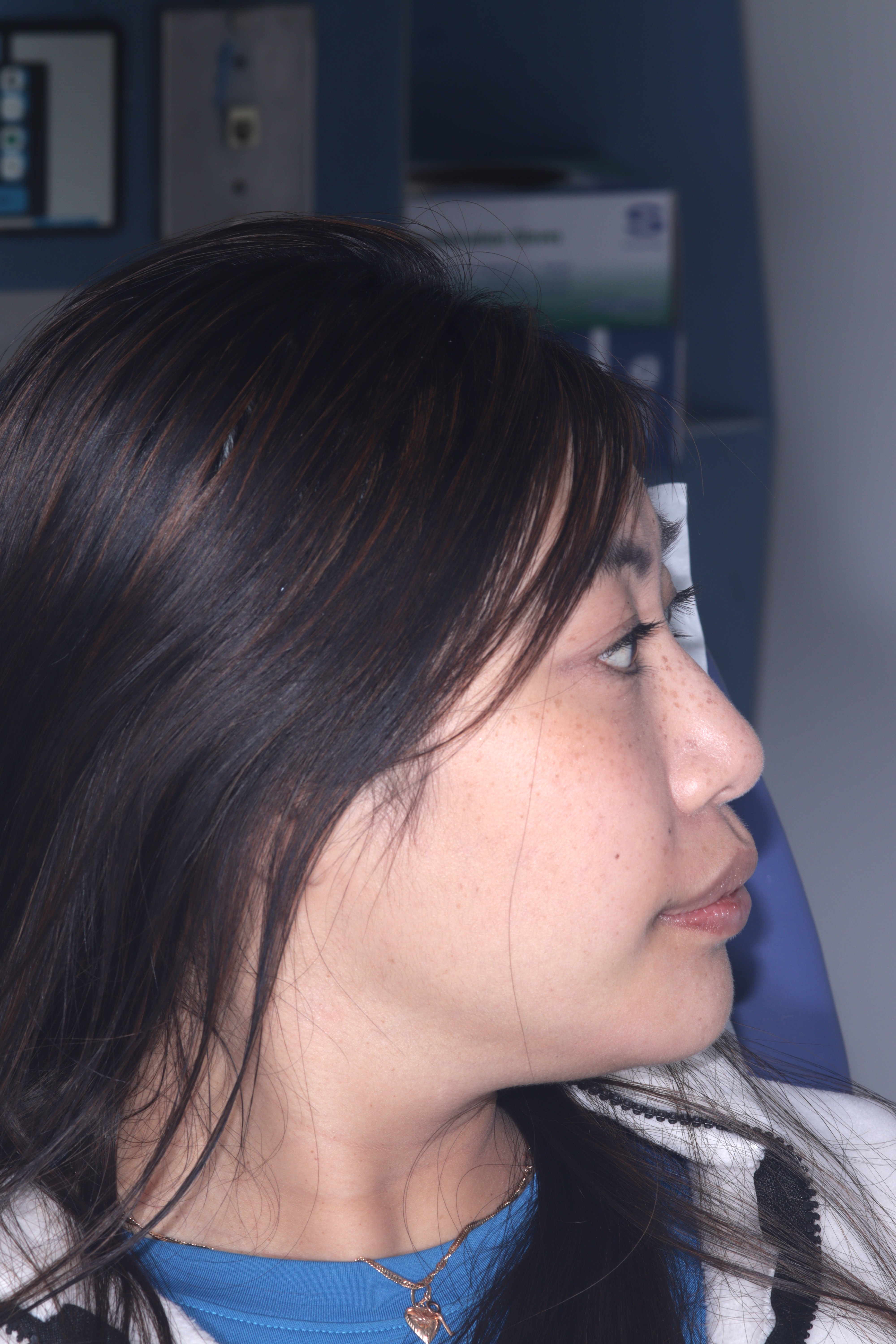 Case 05, Female patient facial profile before vertical dimension restoration