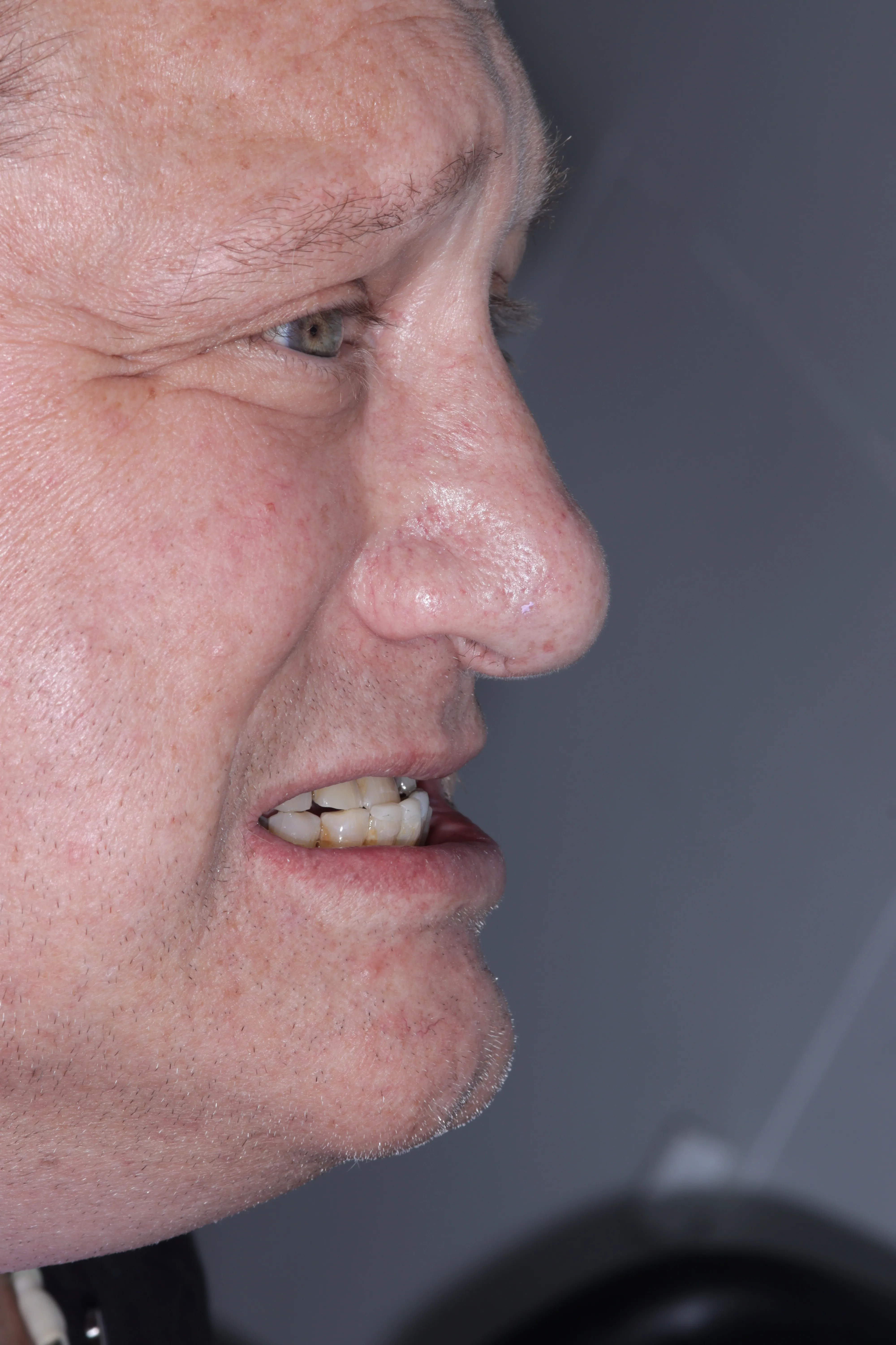 Case 10, Non-surgical open bite and class bite Correction